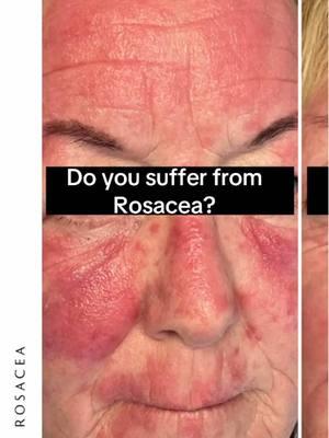 Symbio-12 from @Roccocobotanicals is the ultimate skin-soothing serum. Modulating the skin’s circadian rhythm and protecting against blue light, this lightweight, ultra-hydrating serum instantly envelops your skin, boosting its volume and banishing fatigue. BioAz Cosmeceutical balances the microbiome, reducing inflammation and infection. Rapidly repairs the skin barrier, smooths wrinkles, and is safe for all skin types. This powerful live probiotic serum calms inflammation and nurtures the skins microbiome. #roccocobotanicals #rosaceatreatment #rosacea #microbiomeskincare 