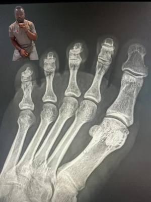 X-rays! #greenscreen #footpain #toepain #injury #xray #radiology #ouch #brokentoe #xrayvision #chiropractor #healthcare 