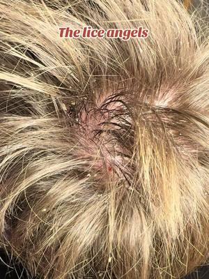 This head lice case breaks my heart #fyp #FY #foryoupage #theliceangels #education #FORYOU #piojos 