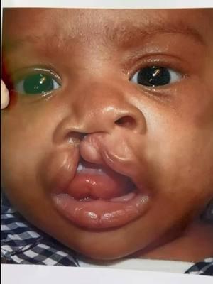 Hi 👋🏼 everyone!! Remember yesterday’s #cleftcutie!? He seen here  BEFORE and immediately AFTER his unilateral cleft lip 👄 and nasal 👃🏼reconstruction. Watch 👀 this video 🎥 to view his on-table cleft lip 👄 and nasal 👃🏼 transformation!  Stay tuned for updates on his progress over the next few weeks and months! Goal: To help make children WITH clefts look like children WITHOUT clefts. Mission: Transforming children’s lives one smile at a time. These images are the property of Dr. Rachel A. Ruotolo and NYPSG and are not authorized for use by any other party. This is my actual patient with real results who has given informed consent (directly or indirectly via parents) to appear on my website and social media pages. #makingsmiles #cleftliprepair #smile  #cleftlip #cleft #cleftmom #cleftdad