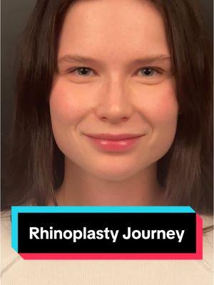 #MODELNOSE What do I mean when I say a model nose after someone has a #rhinoplasty?  This is a specific look a patient is trying to achieve with narrow dorsal aesthetic lines, a well defined tip, and a curve to the nasal #profile. It is very important to understand that this look doesn’t work for every patient. First of all, many patients want a more conservative rhinoplasty, and other patients don’t have the ethnicity, personality, or anatomy to meet the #goal.  Patients, for example, with thick #skin are going to have a more difficult time achieving sharp tip definition and a strong supratip break. During the consultation process, I asked patients to bring in 3 photos of surgeries I  have done that they like.  This helps to understand the #aesthetic goals and to match the surgery to the patient’s requests. This patient is #Ukrainian in background with thin skin and she actually is a #model that came from #Miami to have surgery.  We felt that this #nose would be very appropriate to her facial features, personality, and aesthetic. What a #smile and huge #confidence!