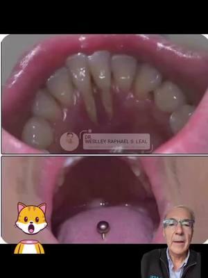 Take a look at what this piercing has done to these teeth! What are your thoughts on tongue bars?! Let us know in the comments 😬😳 Learn how to do this and much more at facialesthetics.org  Learn it. Live it. Give it!  Get AAFE Certification trained today! ° °  ° #AAFE #aafecertified #esthetics #facialesthetics #botox #filler #education 