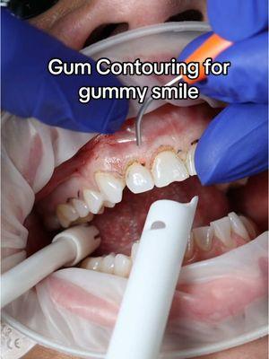 Gum contouring for gummy smile 👄 #gummysmile #gummysmilecorrection #gumcontouring #gummysmiletreatment #gumcontouringwithlaser #lasercontouring #gummysmilereduction 