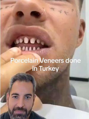 You’re teeth don’t have to be shaved down to nubs in order to have Porcelain Veneers placed 🦷 #porcelainveneers #cosmeticdentist #dentist #smilemakeover #veneers #beforeandafter #beverlyhills #rodeocollection #rodeodrive #dentaloffice #viral #turkeyveneers #greenscreenvideo 