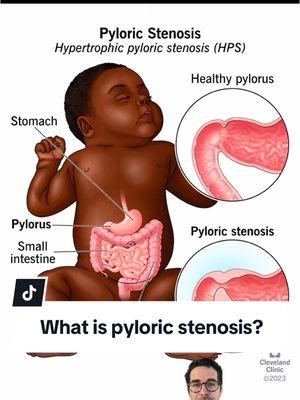 What is pyloric stenosis? #pyloricstenosis #baby #babyreflux #reflux #newborn #newbornbaby #pediatrician #doctoryoshi 