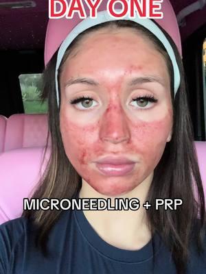 I’ve scared all the people in the coffee shop 😂 but they don’t know how my skin is going to be so amazing after.  #fyp #foryou #prp #microneedling #SelfCare #beautytreatments #girlthings #medspa #forthegirls #girls 