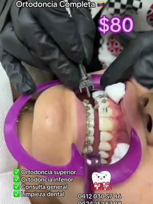 #ortodoncia #brackets #paratiiiiiiiiiiiiiiiiiiiiiiiiiiiiiii #venezuela🇻🇪 #clinicadental #especialista #odontologia #promocion #fyp #protesisdental #caracasvenezuela #vnzla🇻🇪 #saludbucal #xyzcba #odontologo #consulta 