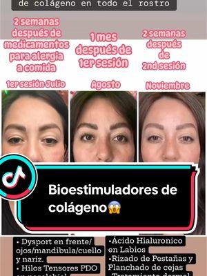 Descubre los increíbles cambios de piel con los BIOESTIMULADORES DE COLÁGENO! 💆‍♀️💖 Cuando se inyecta el bioestimulador, estimula los fibroblastos para generar más colágeno, mejorando firmeza, elasticidad y calidad de la piel. Tu piel se verá más tersa, luminosa y rejuvenecida! ✨👌 Mira la transformación en estas fotos!  Primera fotografía 2 semanas después de una reacción alérgica a comida. Segunda fotografía un mes después de 1er sesión. (Agosto) Tercer fotografía 2 semanas después de 2nd sesión. (Noviembre)  Puedes notar la diferencia?  . . #sheridelsevilla #beautycouturemedspa #PielRenovada #ColagenoParaLaPiel #JovenParaSiempre #PielFirme #RenuevaTuPiel #ColagenoNatural #EfectoLifting #PielRadiante #Bioestimulacion #PielJoven #bioestimuladoresdecolágeno 