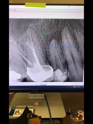 Root canal therapy of tooth #4. #rootcanal #endodontist #dentist #dentists #dentistry #dentalschool #dentalstudent #dentalhygienist #dentalassistant #tooth #teeth #endodontics #eighteeth #toothabscess 