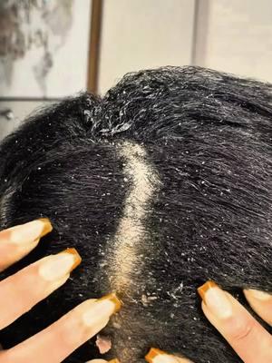 Part 2 #dandruff #dandruffscratching #dandruffremoval #dandruffremovel #asmrvideo #fypage #satisfyingvideos #psoriasis #capcutedit #capcut