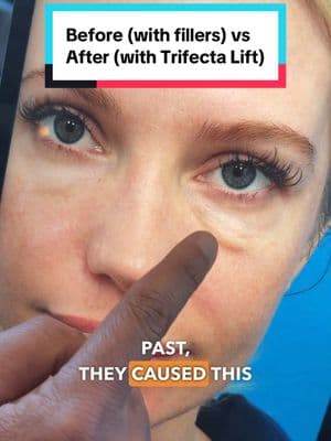 Fillers around the eyes and mid-face should be dissolved before Trifecta Lift. Trifecta Lift includes: lower bleoharoplasty + fat transfer to mid-face + skin tightening. 📍Beverly Hills, CA. #eyes #eyemakeup #eyebags #puffyeyes #darkcircles #kamiparsamd #blepharoplasty #trifectalift 