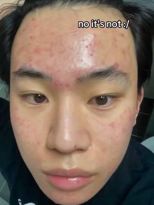 Acne is WAY harder than clear face people make it out to be 😭❤️ credits @Linpascalin #acne #skincare #acnetreatment #pimples #skinpositivity #acnepositivity #skincareaddict #teamacne