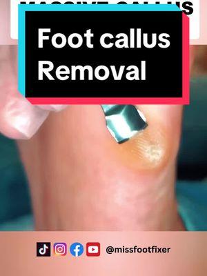 WOW, massive callus removal with gouge By Miss Foot Fixer Marion Yau #massivecallus #callusremoval #callusremover #missfootfixer 