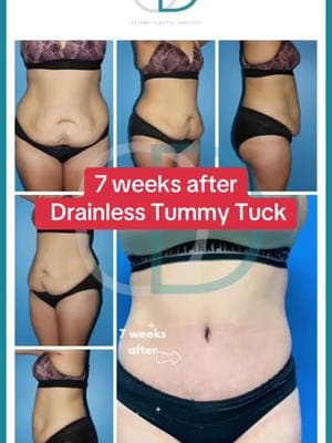 My patient is 6 weeks out of her surgery and is very pleased with her results. She had a #drainlesstummytuck - my signature procedure. It’s a #tummytuck with no drains and aims to remove the excess fat skin around the belly area. It allows me to give you a flatter belly and also #repair the muscles that have separated. To book call us at: ☎️ 832-792-7827 📍 River Oaks • Houston, Texas  Or visit our website at: www.deigniplasticsurgery.com  • • • #deigniplasticsurgery #drdeigni #boardcertifiedplasticsurgeon  #houstonplasticsurgeon #houstonplasticsurgery #fyp #onthisday #happymonday #contentcreator 