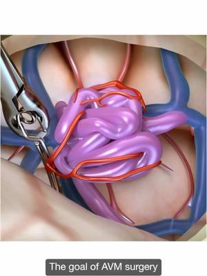 Open surgery and radiosurgery are available treatment options for AVMs. Watch @UCSF Benioff Children’s pediatric neurosurgeon Dr. Winson Ho and pediatric vascular neurologist Dr. Christine Fox explain the differences between these approaches. #AVM #AVMAwareness #ArteriovenousMalformation #UnitedandRare #neurosugery #SciArt #MedicalArt #MedicalIllustration 