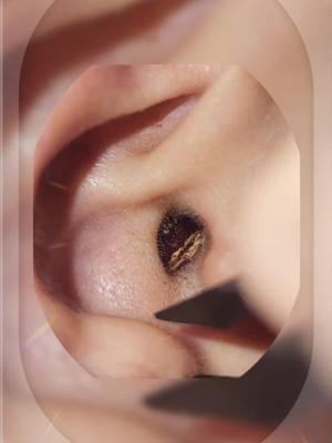 #pimple #foryou #earwaxremoval #earcleaning #earwax #blackhead #earwaxirrigation #relax 