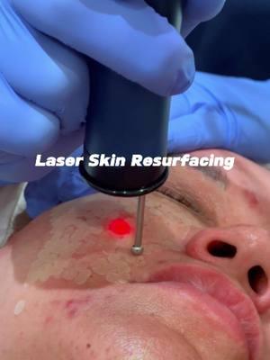 Cool Laser in action ! What does it do ? A lot !!! #laser #bestresults #pchmedspa #ablativelaser #newskin #refreshskin #wow 