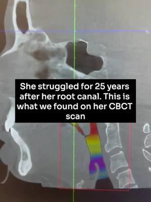 The bone is being destroyed because of that infection and that failed root canal. And it's leading to this.... This is why I don't recommend root canals. They lead to infection. Instead If your tooth is still alive (and there can be vitality tests done to see if it’s alive) then try to save it with an ozone treatment. If your tooth is dead, then have it extracted and get a ceramic implant. If you have already had a root canal, depending on how long you’ve had it for, it could already be infected and you have no idea. Get it replaced with a ceramic implant or use a cone beam ct scan to see if it’s infected or not. #conebeamctscan #cbctscan #infectedtooth #toothinfection #holisticdentist #biologicaldentist #functionaldentistry #teeth #rootcanal #dangersofrootcanals