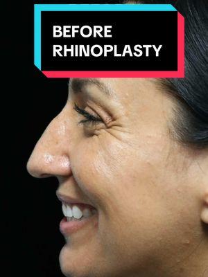 No cookie cutter template Rhinoplasty surgery here. Customized Finesse based on patient desires. This patient is 9 months post-op from her closed Scarless Nose®️ Rhinoplasty- she desired a “natural refinement she could have been born with”. The art for me isn’t creating a new template nosejob in every patient. The art is in finding the best version of a nose within the patient’s anatomy. The best version of you.  For immediate assistance, visit: https://www.scarlessnose.com/contact and our concierge team will respond promptly!  Ready to book a consultation? Visit https://www.scarlessnose.com to schedule a virtual or in-person consultation.  At Beverly Hills Rhinoplasty Center, Dr. Dugar exclusively performs Closed Scarless Nose® Rhinoplasty as 100% of his surgical practice! 🌐 Scarless Nose® https://www.scarlessnose.com 📞 Call/text (USA): (424) 722-3484 🌍 International Patients (WhatsApp): (+1-310-276-1703) 🔗 Immediate Assistance: https://www.scarlessnose.com/contact/ 📍 Beverly Hills Rhinoplasty Center, Beverly Hills, CA #nosejob #rhinoplasty #scarlessnose #closedrhinoplasty #bestrhinoplastysurgeon #scarlessrhinoplasty #bestrhinoplasty #scarlessnosejob #bestnosejob #drdugar #fyp