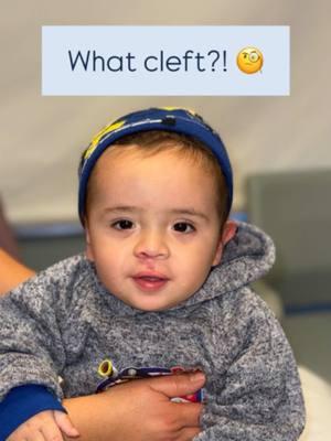 Hi 👋🏼 everyone! Meet our sweet 🥰 #cleftcutie who is 1 year following his cleft lip 👄 repair!  (**Note: This baby was also born with a vascular malformation/birthmark along his upper lip. This additional anatomic finding made his cleft lip repair much more challenging!!!) Watch to see him BEFORE his cleft lip repair.  It is so important for parents to try and be patient with the healing process. The scars are often very pink and firm for at least 4 months, and then they usually finally start to soften and fade!  Goal: To help make children WITH clefts look like children WITHOUT clefts. Mission: Transforming children’s lives one smile 😀 at a time. These images are the property of Dr. Rachel A. Ruotolo and NYPSG and are not authorized for use by any other party. This is my actual patient with real results who has given informed consent (directly or indirectly via parents) to appear on my website and social media pages.  #cleftlip #cleftcutie #cleftliprepair #cleft #cleftpalate #cleftpalaterepair #hemangioma #vascularmalformation