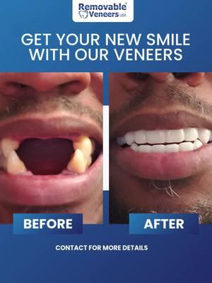 Transform your smile effortlessly and boost your confidence instantly! 😁✨ Start your journey at removableveneersusa.com today. #RemovableVeneers #RemovableVeneersUSA #DreamSmile #EffortlessBeauty #SmileTransformation #SnapOnVeneers #DentalSolutions Click Here For More Details: https://removableveneersusa.com/