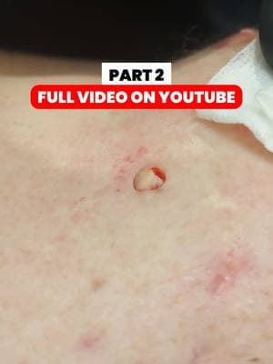 #pimplepopper #pimplepopping #thedoc #thedoctok #drmudgil 