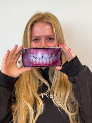 🥹 ending with our signature transformation video style- where are we supposed to share these incredible new smiles now?! #goodbyetiktok #tiktokban #ban #smiletransformation #perfectteeth #beforeandafter 