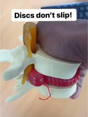 Are “slipped discs” fake? This term is widely used in reference to disc injuries, implying something has moved out of place In reality, these discs are attached to the vertebrae above and below them, and they are not freely moveable Instead, what is moving is the inner gel-like substance called the nucleus pulposus This inner gel of the disc is surrounded by a tough outer layer called the annulus fibrosis When the inner gel pushes outwards into the outer layer it can form a disc bulge When the outer layer tears and the inner gel pushes through it can form a disc herniation And when the disc pushes far enough to impact a nerve, it can cause radiating pain into the glute, down the thigh, down the calf, and even into the toes Commonly, there can be numbness or tingling as well when a nerve is affected There are varying degrees of herniation: Smallest: Protrusion Middle: Extrusion Biggest: Sequestration The GOOD NEWS is that based on the current evidence, the larger the herniation, the higher the chance of healing! So this is why you do not want to rely purely on imaging for your disc herniation prognosis, as imaging can provide unnecessary scary narratives and push you towards surgery or injections when it is not indicated. And 97% of disc herniations can be resolved WITHOUT SURGERY through a proper rehab plan! So if you felt: - a pop in your low back - worse the longer you sit - worse bending forward - hard to stand up straight after sitting You may be dealing with a disc injury. But don’t worry! We work with this every day, and it is highly recoverable without drugs or surgery, you just need a plan! ✅ Want to learn how to fix your disc injury? DM me the word “disc” and you will get a free 1:1 disc fix consultation with us! . . 👣 follow @rehabfix . #discherniation #sciatica #sciaticarelief #sciaticapain #backpain #backpainrelief #lowbackpain #spine #movement #physio #move #getstrong #spinehealth #mobility #painfree #backpainrelief #lowbackpainrelief #sciaticarelief #discherniationrecovery #discbulge