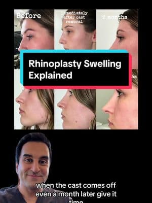 As a rhinoplasty expert, I often see confusion around the healing process, especially about swelling. Watch how swelling decreases from 1 week to 8 months after surgery. Patience is key!   Learn more:  Call/text (USA): (424) 722-3484 International Patients (WhatsApp): (+1-310-276-1703) Immediate Assistance: https://www.scarlessnose.com/contact/  #nosejob #rhinoplasty #closedrhinoplasty #bestrhinoplastysurgeon #rhinoplastyswelling #rhinoplastyhealing #scarlessrhinoplasty #bestrhinoplasty #scarlessnosejob #nosejobswelling #bestnosejob #drdugar #fyp