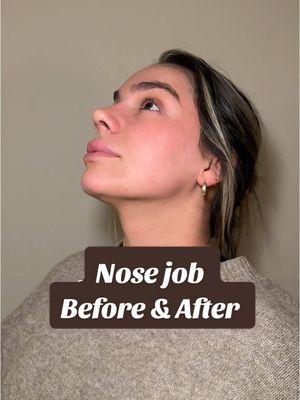 Breaking up with my old nose was the best decision of my life so far! 10/10 recommend.👃🏼✨🇹🇷🧿 #turkeyrhinoplasty #turkeynosejob #newnose #nosejobresults #surgeryinturkey #nosejob #rhinoplastybeforeandafter #nosejobcheck #nosejobbeforeandafter #rhinoplastyresults 