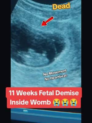 11 Weeks fetal Demise inside Womb during ultrasound scan #babyultrasoundscan #babyultrasound👣💙 #babyultrasoundpost✨ #fetaldemise #fetaldemis #11weekspregnant #11weekspregnant #11weeksold 