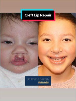 Hi 👋🏼 everyone! Watch the following Reel 🎥  cataloging Valentina's progress over the last 9.5 years following her cleft lip & palate reconstruction.  Where does time 🕰️ go?! 🤷🏻‍♀️ It is so very important for parents to see and understand the many changes that occur to the lip, nose and scar during the months and years following their child’s cleft repair.  The lip is often pink and firm for months after the surgery. The scar may also contract, causing shortening of the lip making it appear as if the cleft is recurring. 😳 I try my best to reassure parents along the way, as so much changes over time. Some changes will require operative intervention, and others just need patience. 😇 👼  As you can see in this video 🎥, patience and time ⏰ are essential in allowing the lip and nose to soften and settle. 👌🏻 Mission: Transforming children’s lives, one smile 😃 at a time.  Goal: To help make children WITH clefts look like children WITHOUT clefts 💪🏻👌🏻.  These images are the property of Dr. Rachel A. Ruotolo and NYPSG and are not authorized for use by any other party. This is my actual patient with real results who has given informed consent (directly or indirectly via parents) to appear on my website and social media pages. #cleftlip #cleft  #cleftbaby #lip #lips #nose #smile #cleftcutie 