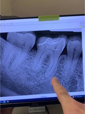 Kept locating canals! RCT of tooth #30. #endodontics #endodontist #dentistry #dentist #dentists #dentistryschool #dentalschool #dentalhygienist #dentalassistant #toothache #tooth #teeth #rootcanal #rootcanaltherapy 