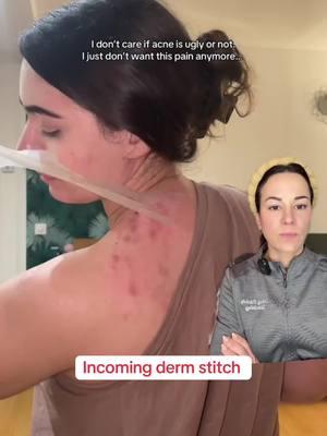 Stitch with @Selflove_aida and thank you for sharing. Body acne can be painful and frustrating and if you don’t have access to a dermatologist, these are a few things to try at home #dermguru #dermreacts #backne #bacne #bodyacne #hypochlorousacidspray #greenscreen 