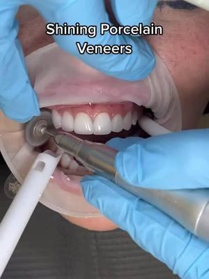 Shining porcelain veneers 🫧💎 #porcelainveneers #dentalveneers #teethcleaning #deepcleaning #dentalcleaning #naturalveneers #onthisday 