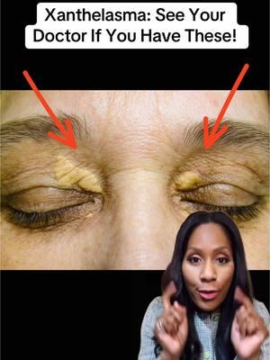 Xanthelasmas!  #xanthelasma #xanthelasmaremoval #highcholesterol #elevatedlipids #hyperlipidemia #drjencaudle #fyp #fypシ゚viral #fypシ 