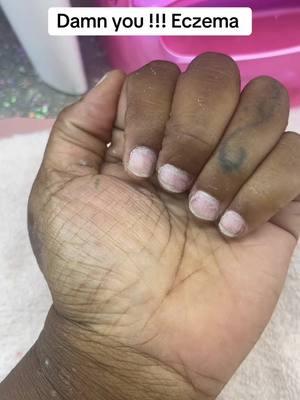 I hate the way my hands look now and has really made me insecure😢😢😢😢BUT I’m tired of my nails being boring #eczema #inscure #fyp #skinproblems #nailtechlife 