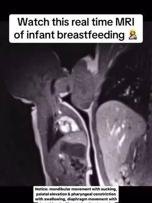 How Breastfeeding Works 🤱 Breastfeeding operates on a beautifully designed system of supply and demand! The more your baby nurses or milk is removed, the more signals your body receives to produce milk. This process is powered by two incredible hormones: ✨ Prolactin: The 'milk-making hormone,' responsible for producing breast milk. ✨ Oxytocin: Known as the 'love hormone,' it triggers the letdown reflex, releasing milk to your baby while fostering a sense of calm, relaxation, and connection for both of you. 💕 Frequent nursing, skin-to-skin contact, and responding to your baby’s feeding cues are key to keeping this amazing system running smoothly. Your body is designed to adapt perfectly to your baby’s needs – the more milk removed, the more milk your body makes! 🌟 This process is a testament to how intricately nature supports both nourishment and bonding. 🎥 Video from Ph.D. research by Dr. Nikki Mills, University of Auckland, New Zealand. Images published in her groundbreaking paper, “Imaging the Breastfeeding Swallow: Pilot Study Utilizing Real-Time MRI,” in Laryngoscope Investigative Otolaryngology. 📚 #BreastfeedingJourney #SupplyAndDemand #Oxytocin #Prolactin #BabyBonding#BreastfeedingEducation #SupplyAndDemand #Oxytocin #MilkProduction #BreastfeedingSupport #NewMomTips #LoveHormone #BreastfeedingJourney