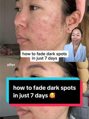 AD #INNISFREE_partner can’t believe how fast this serum works @Innisfree US @Innisfreeofficial  #INNISFREE #7daysDarkSpotChallenge #vitaCRapidDarkSpotSerum #glassskin #darkspots #koreanskincare #viralvitaminc #Sephora