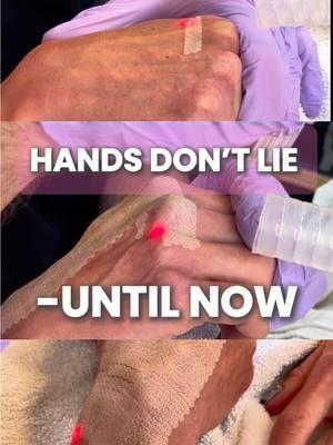 Hands don’t lie, until now!⚡️🤚🏻 #hand #laser #rejuvenation #aesthetics #antiaging #beforeandafter #medspa #doctor #lasers #trending #viral #relatable #doctorsofyoutube #doctorsoftiktok #face #nonsurgical #fyp #foryoupage #viral 