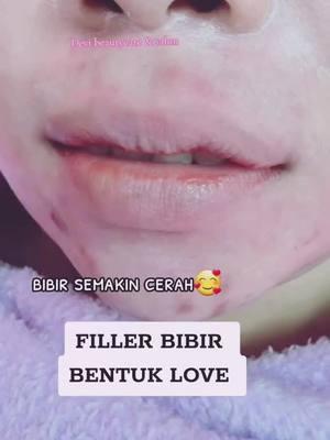 #padahariini #filler #fillerbibir #fillerbibirhongkong #fillerhongkong #fyppppppppppppppppppppppp #promoperawatanhongkong #viral #promoperawatanwajah #hongkong #devibeautycare_123 #devi_beautycare_salon #perawatankecantikan #fyp #perawatankecantikanhongkong 