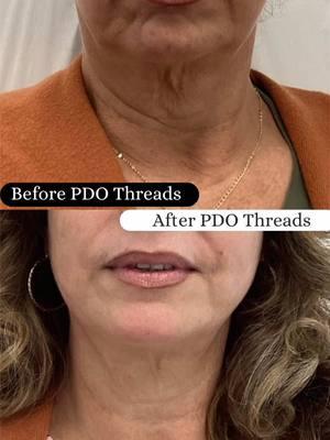 Non-Surgical Facelift Transformation with PDO Threads at Beyond Health MedSpa In this photo, we showcase the amazing before-and-after results of a non-surgical facelift using PDO threads. Notice the significant skin tightening around the neck and mouth, offering remarkable rejuvenation and enhanced skin firmness. Our patient is thrilled with her results, enjoying a younger-looking face and more defined contours without the need for surgery. 🌟 Learn more about our facial rejuvenation treatments and how they can benefit you by visiting beyondhealthmedspa.com or calling us at (786) 359-4068 to schedule a consultation. #PDOTreads #NonSurgicalFacelift #BeforeAndAfter #BeyondHealthMedSpa #MiamiMedSpa #FacialRejuvenation #SkinCare #Miami #hilostensores #pdo #pdothreadlift @VSoftLiftUSA @Renovatio PDO ™ @Y pena 10 @Odys N Hernandez 