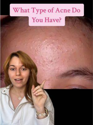 Knowing your type of acne and finding the root cause is step one in clearing your skin! #acneproneskin #esthetician #cloggedpores #cloggedskin #acnejourney #skincareroutine #adultacne #inflammatoryacne 