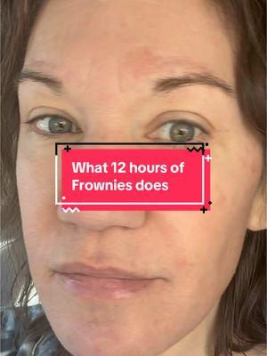 I wore Frownies wrinkle patches for 12 hours. Let’s see the results together. @Frownies #frownies #wrinklepatches #wrinkles #skin #marureskin 