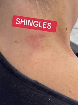 #shingles #60s #50s #70s #virus #shinglesvirus 