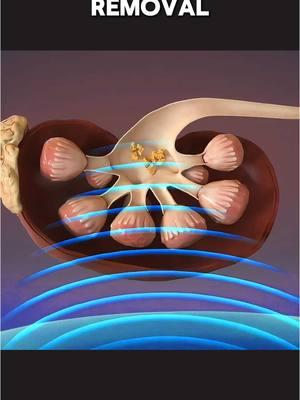 Shockwave Lithotripsy (3D Animation) | Kidney Stones Removal #shockwavelithotripsy #kidneystone #kidneystonesurgery #kidneystonesremoval #shockwavetherapy #medical3danimation #3dmedicalanimation #kidneystonetreatment #kidneystoneproblem 