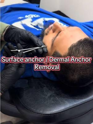 This implant has been in for years!!  All dermal anchors are a semipermanent piercing implant! The jewelry anchor has holes in it that fill in with tissue when it heals and this is how it sits inside but once removed this would be the procedure— some are easier than others and don’t require the help of a needle 🪡 👍🏽  #fyp #dermalremoval #surfaceanchorremoval #trending #piercer #bodypiercer #piercinghelp #morenovalley #riverside #california #socal #certified #piercingsoftiktok #piercingtiktok #piercingvideos #removal 