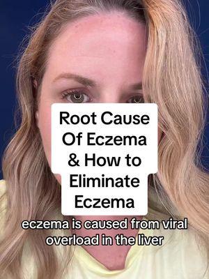 The Eczema Protocol. Natural treatment for Eczema. Kids Eczema. Infant Eczema. #eczema #eczemaawareness #eczemaflareuprelief #eczematok #eczemahealing 