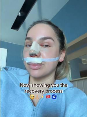 My nose job diary continues 👃🏼✨🇹🇷🧿 #nosejob #nosejobcheck #newnose #nosejobreveal #nosejobresults #rhinoplasty #postingdrafts #postingmydrafts #tiktokban #riptiktok #goodbyetiktok #byetiktok #draftvideo 