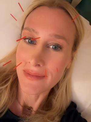 Who else is not getting fillers or tox and is doing Acupuncture?  #acupuncture #facialacupunture #modeltips #beautytips #skincareroutine #beautyhacks #weeklywellness #modelskincare #themodelmentor 